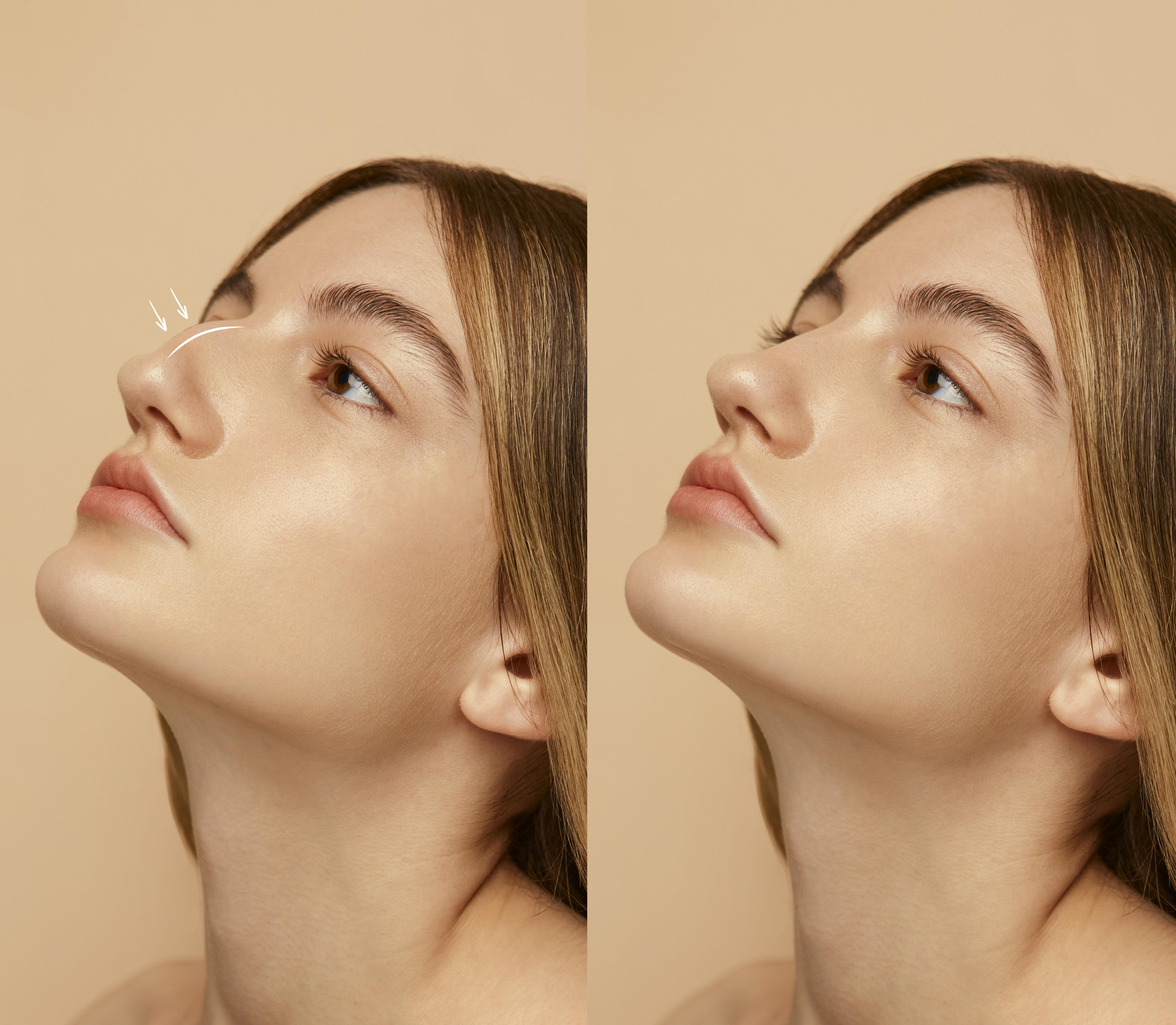 Neuscorrectie voor gezichtsfeminisatiechirurgie (FFS) 6 vrouw die zich klaarmaakt voor een neuscorrectie