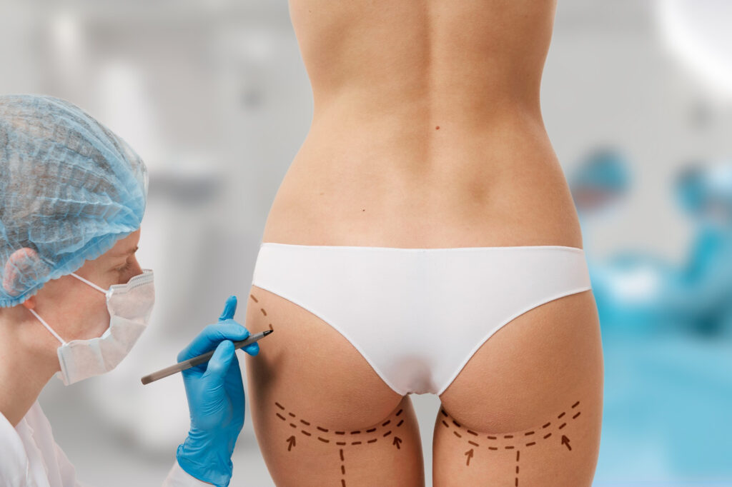 Técnicas de contorno corporal para una silueta femenina: liposucción, realce de glúteos y aumento de cadera Mujer marcada cirugía estética.