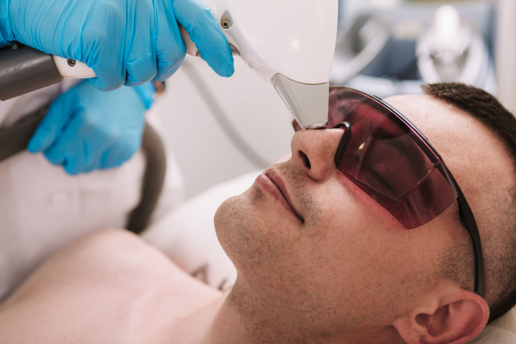 ¿Cuándo es el mejor momento para iniciar la depilación facial antes de la FFS? imagen 1