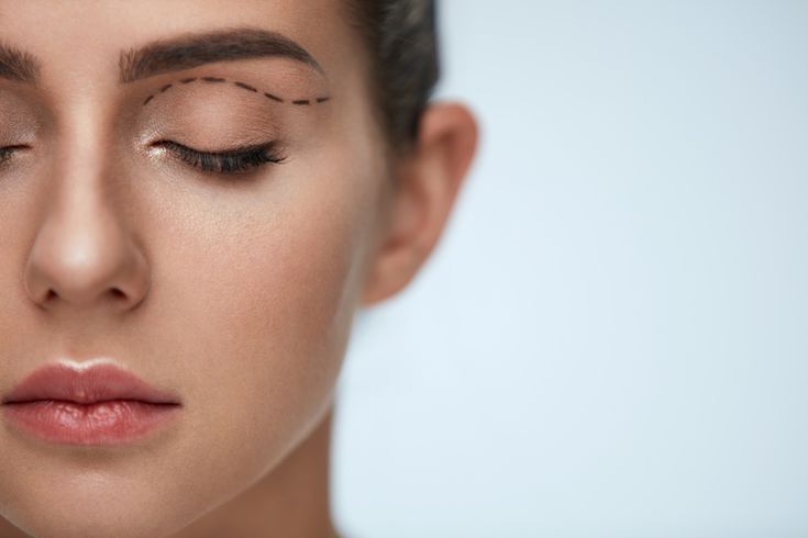 4 Stappen in Hoeveel Kost Een Wenkbrauwlift? 2 chirurgie