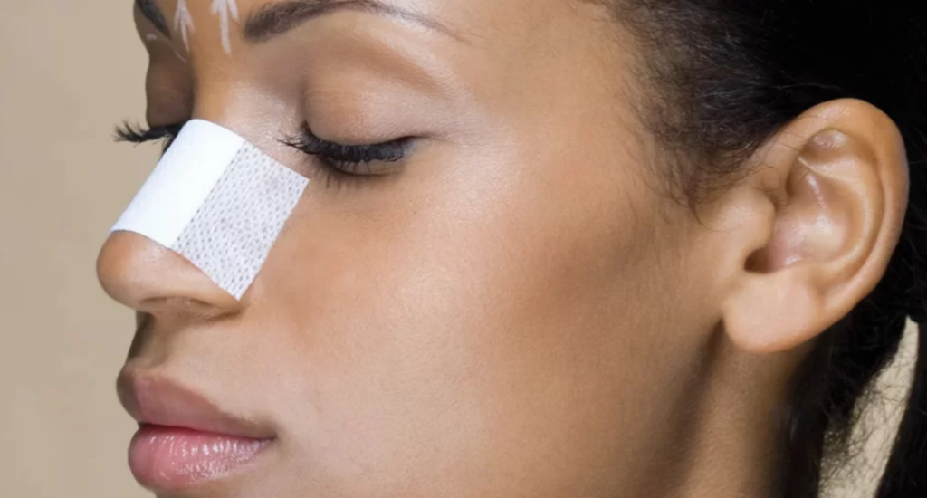 Trendy Look with Rhinoplasty in Turkey 1 271 142420