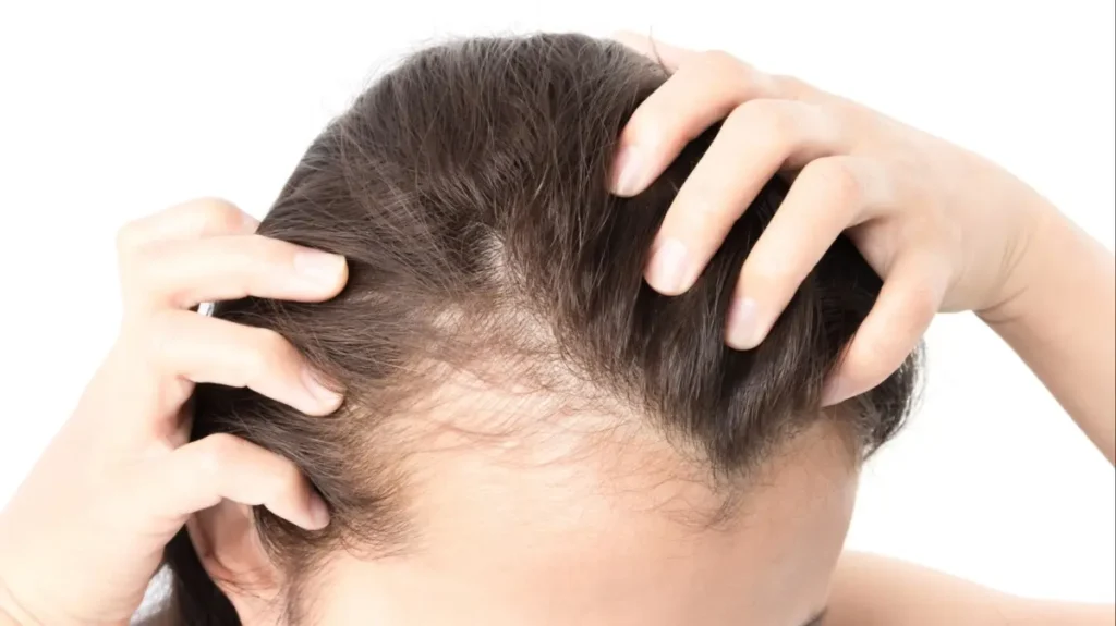 Chirurgie d'abaissement de la ligne des cheveux : points importants à connaître 2 chirurgie