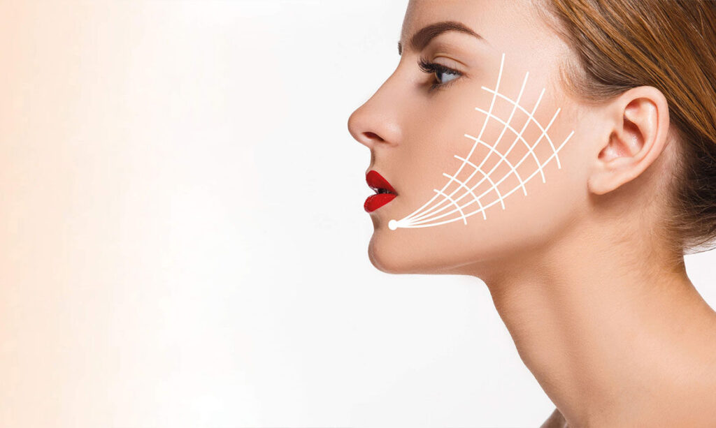 Cheek Implants and Midface Lift: A Double Action Solution for an Attractive Face 9 midface trans