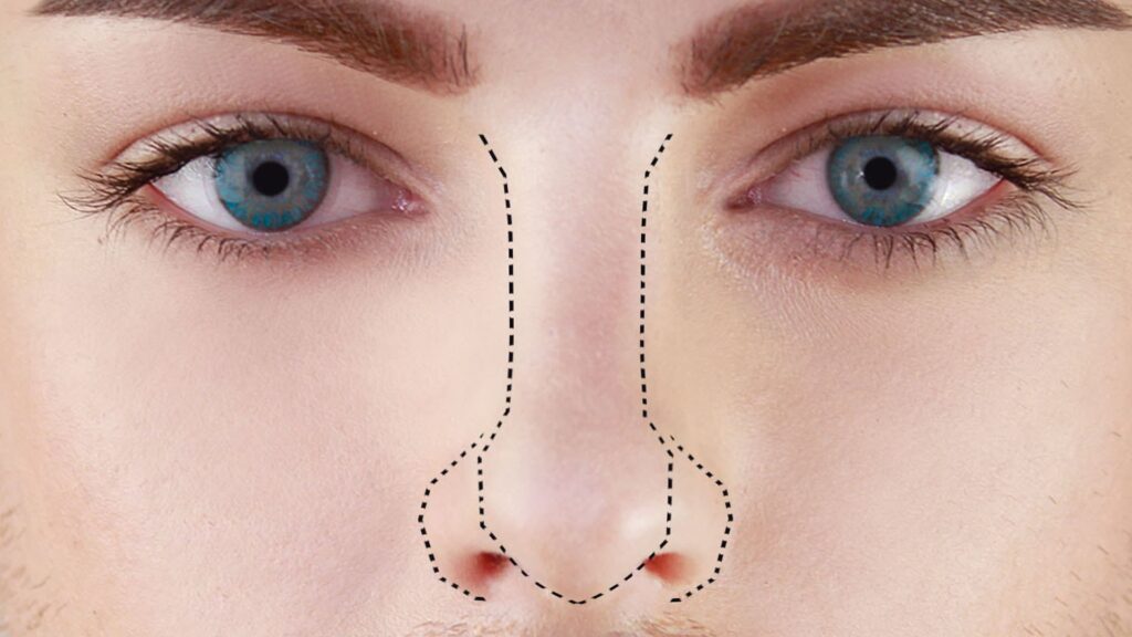 Reducción de la base alar y cirugía de la punta nasal en la feminización facial: una guía para una nariz más bella nariz