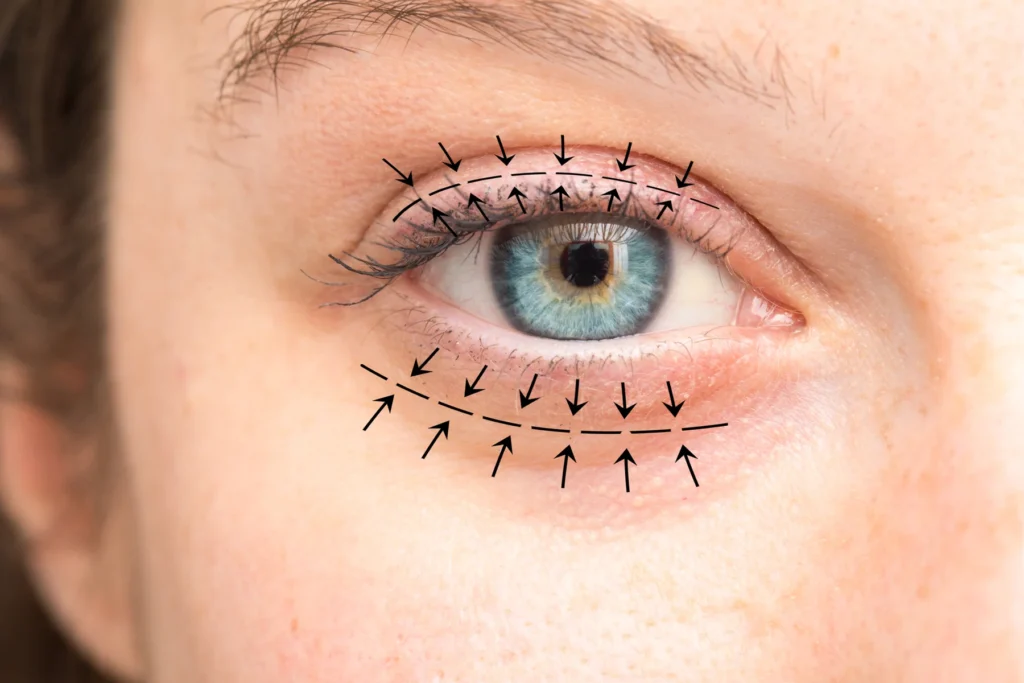 Canthopexie ou canthoplastie ? Laquelle vous convient le mieux ? Canthopexie
