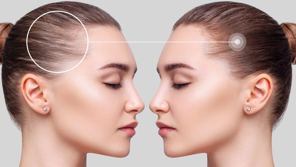 ¿Es posible un levantamiento de frente con aumento de la línea del cabello? Enfoques prácticos para la feminización facial moc