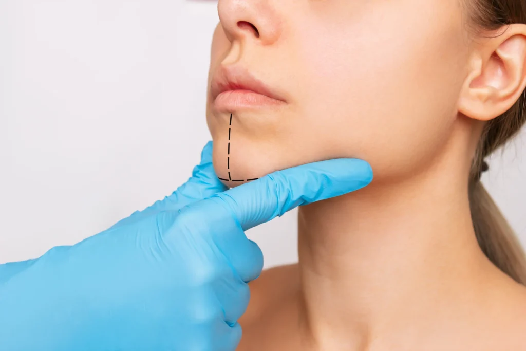 Pourquoi la chirurgie de réduction du menton est-elle importante pour le processus FFS ? 1 liposuccion du menton