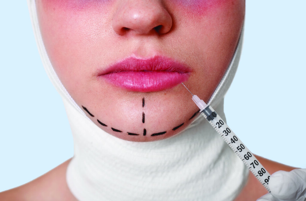 Pourquoi la chirurgie de réduction du menton est-elle importante pour le processus FFS ? 2 réduction du menton