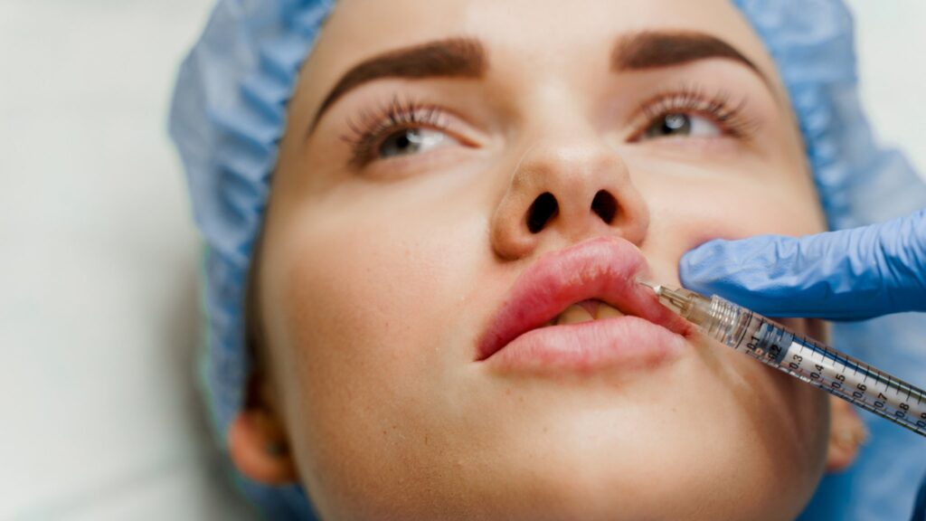 Making the Midface More Feminine: Which Procedures Are Combined with Lip Augmentation? 3 midface and lip
