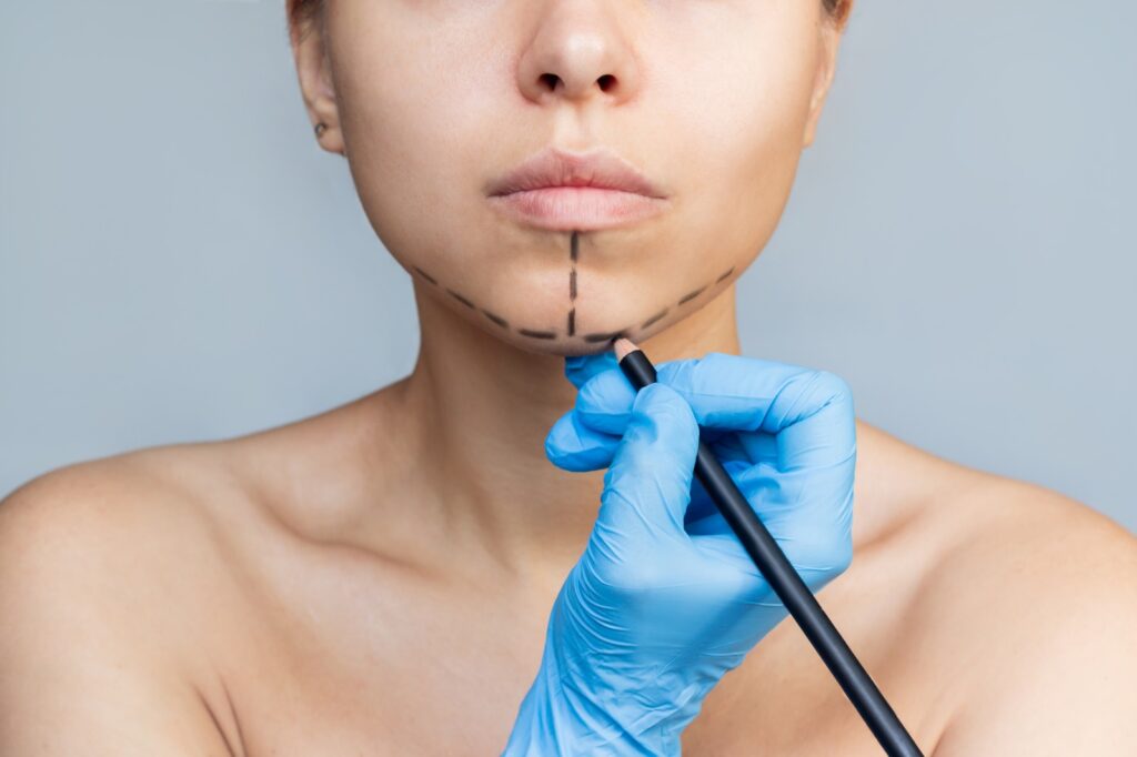 Chin Surgery in Facial Feminization: Are Chin Implants or Chin Shaving More Effective? 2 surgery