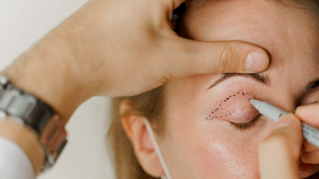 تجميل الجفون للحصول على مظهر طبيعي وشبابي جفن