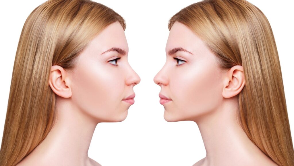 L’asymétrie de la mâchoire nuit à l’apparence féminine : quelles sont les solutions ? Chirurgie maxillo-faciale