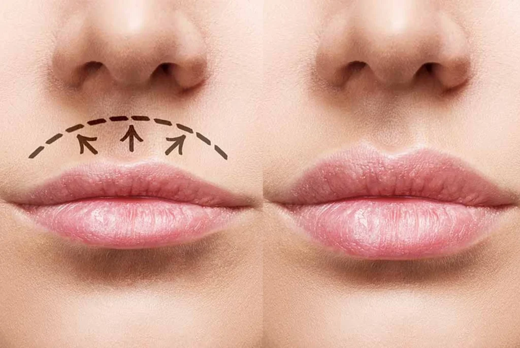 Lippenlifting-Filler