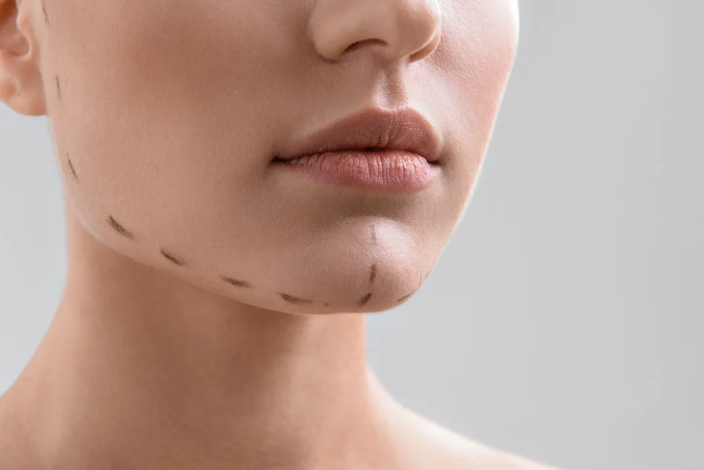 Kunnen een kinverkleining en een liposuctie van de onderkin tegelijkertijd worden uitgevoerd? 3 dubbele kin3